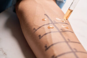 Hauttests bei Histaminintoleranz