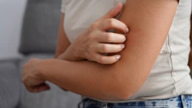 Hautreaktion durch Hitze bei Histaminintoleranz